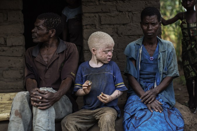 У Малаві спостерігається різке зростання числа вбивств людей з альбінізму, йдеться в звіті «Міжнародної Амністії», опублікованому 7 червня