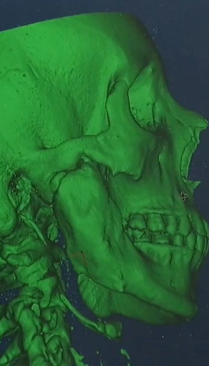 На принтерах випікаються титанові суглоби, щелепи і частини обличчя, які потім замінюють уражені кістки
