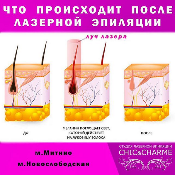 Видалення волосся спеціальною лазерною насадкою проводиться практично у всіх великих салонах Москви і інших великих містах