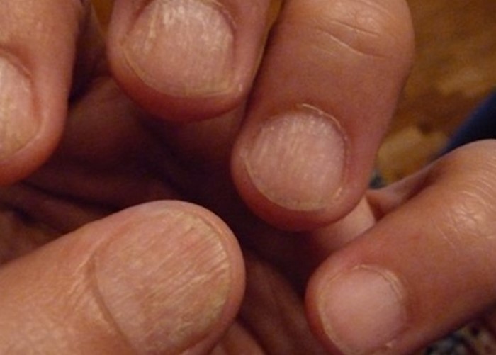 Хвилясті нігті на руках - тобто, які відзначені горизонтальними хвилями або гребенями, як правило, є результатом медичного стану, відомого як лінії Бо